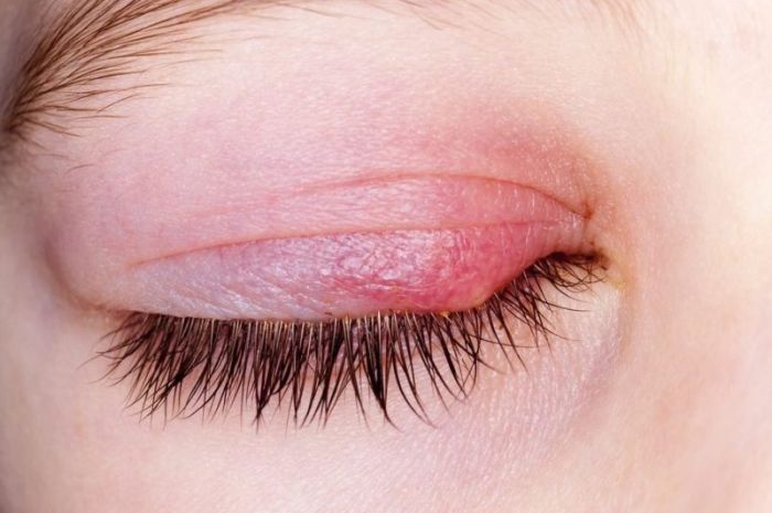 cu ce se trateaza ulciorul de la ochi tratament cancer de ochi