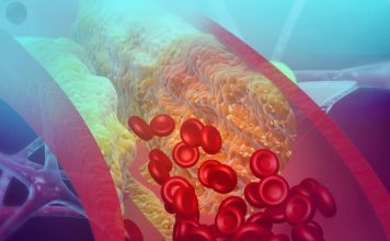 Cum Scazi Colesterolul Rău cu 10 Leacuri Bătrânești leacuri-batranesti-pentru-colesterol-scazut